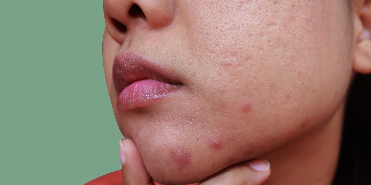 What Causes Chin Acne and How to Treat It, According to Dermatologists