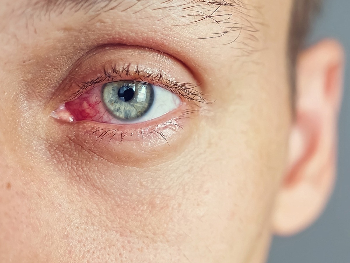 Eye Infection Symptoms: 5 Warning Signs You Should Never Ignore