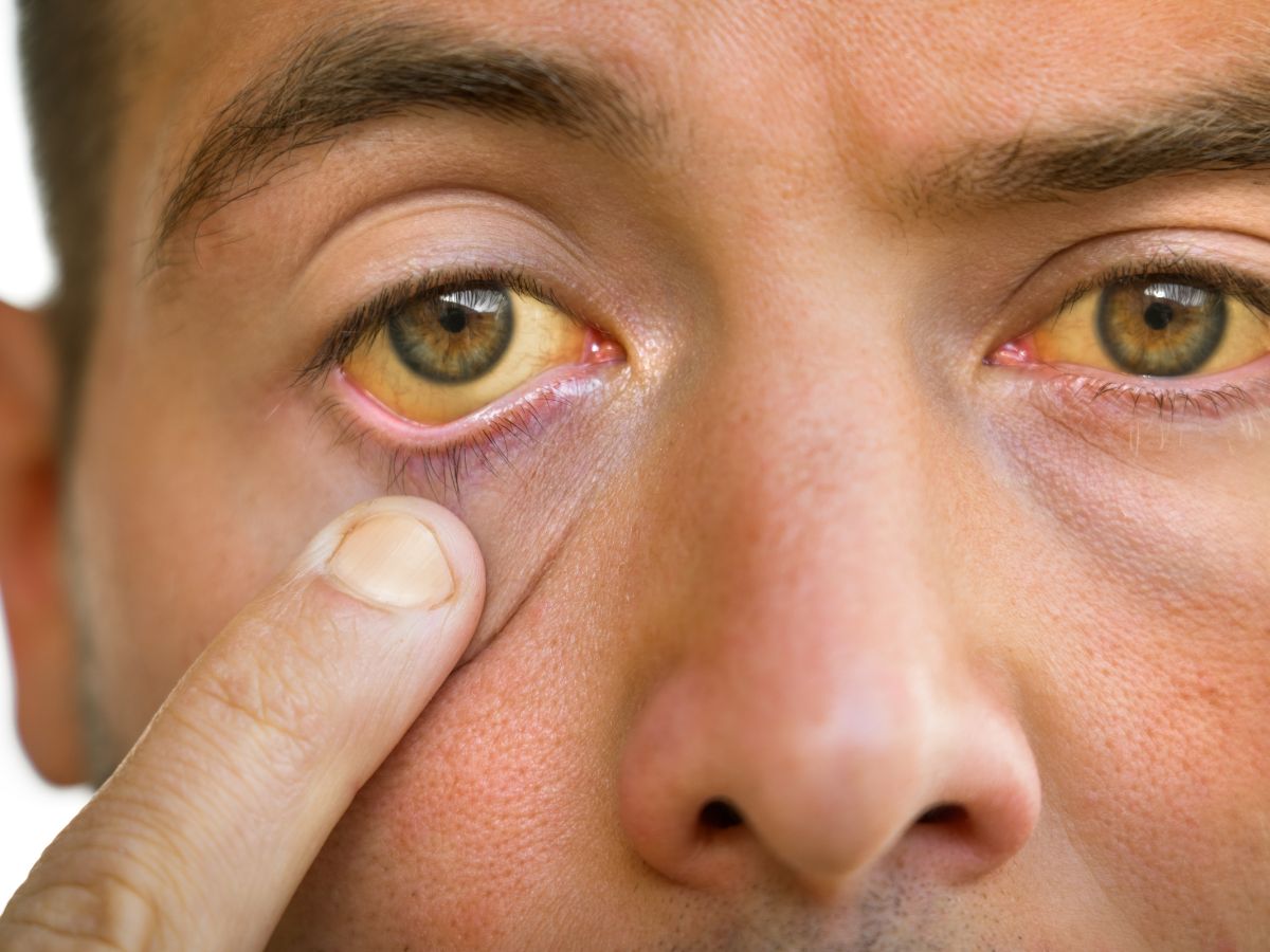 High Cholesterol Symptoms: These 7 Signs In Eyes Can Tell If You Have High Cholesterol