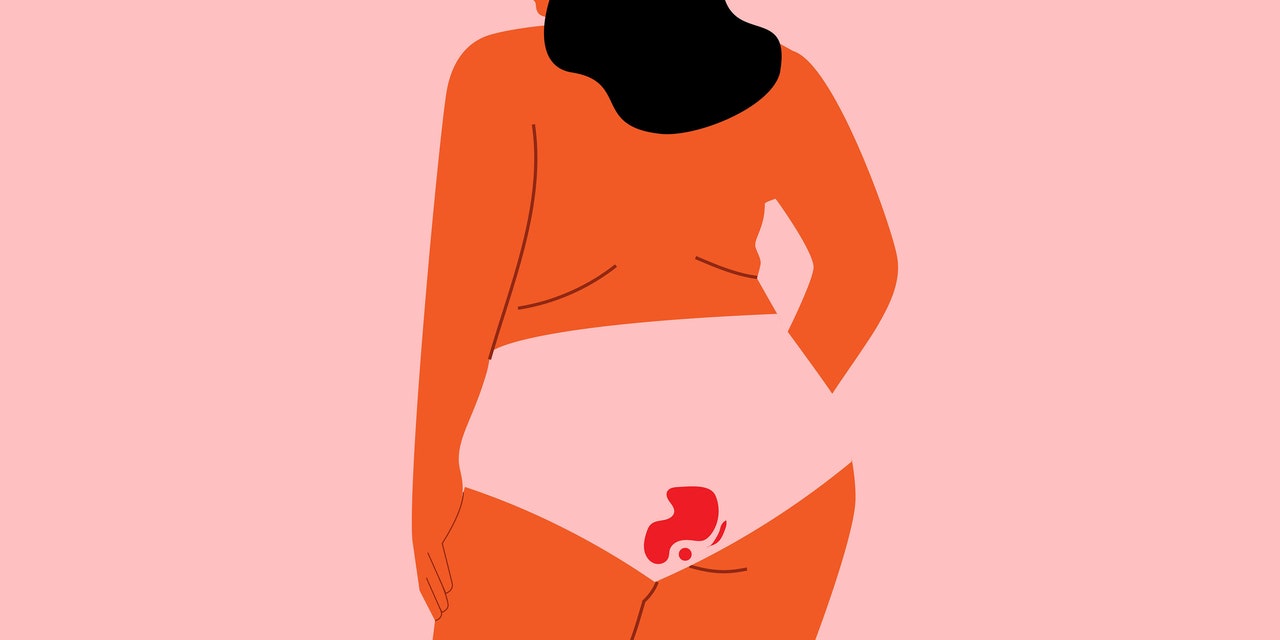 How to Treat Heavy Periods With Uterine Fibroids