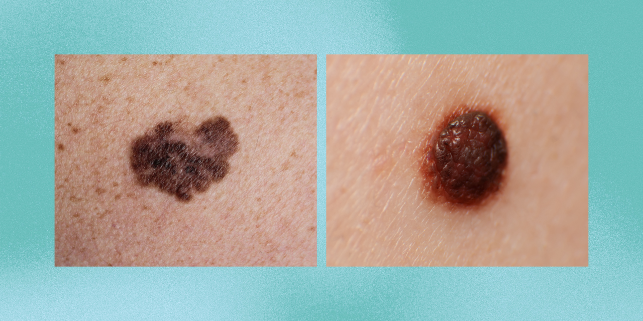 How to Tell If Your Suspicious Mole Might Be Skin Cancer