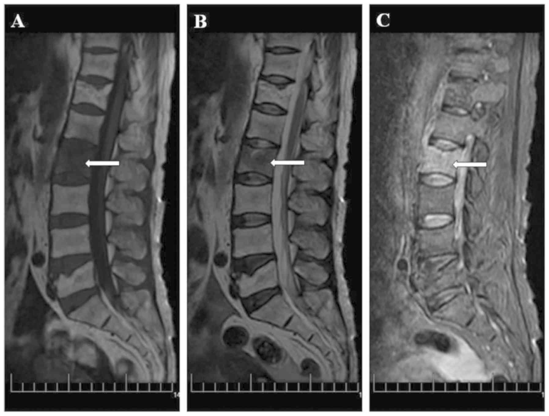 Spinal Tuberculosis Is Curable: Timely Detection And Medical Treatment