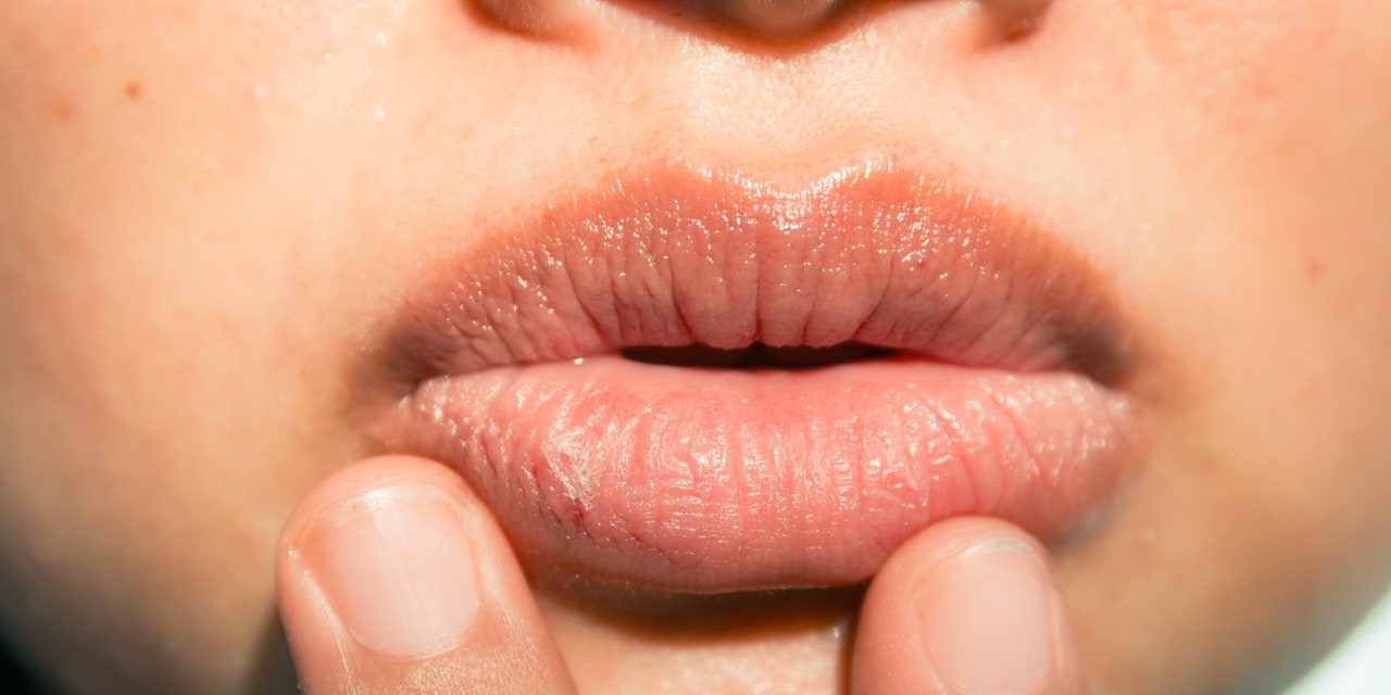 6 Major Causes of Chapped Lips and How to Treat Them