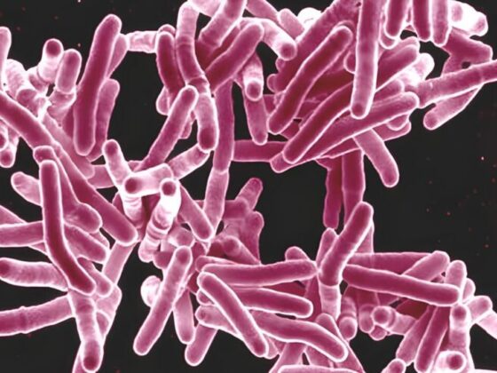 Tuberculosis: Warning Medieval disease is on the rise as cases surge across UK