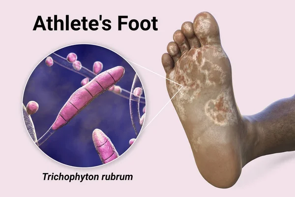Athlete’s Foot Condition And Treatment | Stock Photo