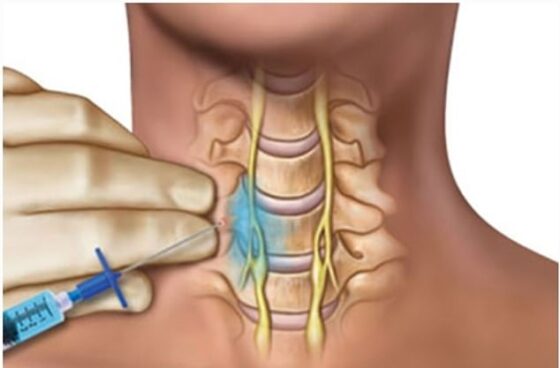 Doctors are not certain why exactly this procedure was so effective for regaining sense of smell, but there is a prevailing hypothesis that injecting and numbing some of the sympathetic nerve tissue recalibrates the body's nervous system to pre-Covid condition. Photo courtesy of Nevada Comprehensive Pain Center