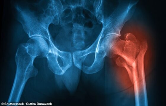 Injuries such as hip fractures (pictured) can trigger complications such as heart problems. The Royal Osteoporosis Society (ROS) claims the deaths are the result of a postcode lottery in bone screening services run by NHS hospital trusts