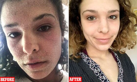 Shocking before and after pictures of eczema-stricken student with steroid withdrawal 