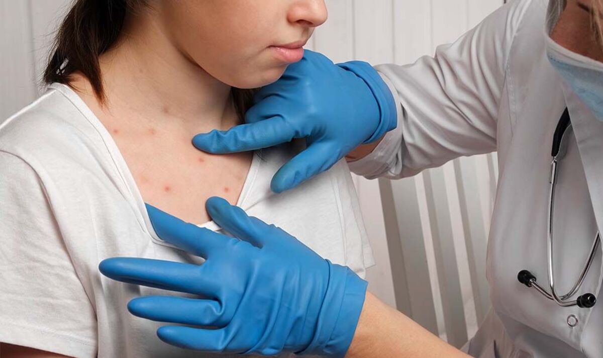 'I'm a doctor - here are six things you need to know amid the measles outbreak in the UK'