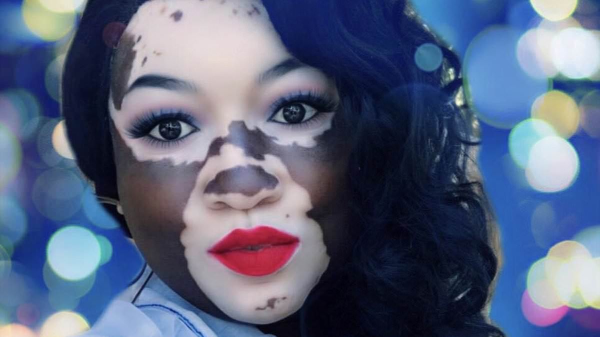 Black woman, 43, with vitiligo claims her skin condition has been partly REVERSED after suffering two STROKES