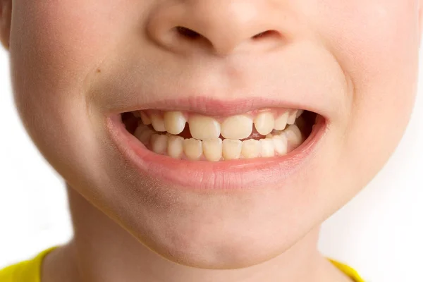 Can serum vitamin D cause dental caries or molar incisor hypomineralisation in children?