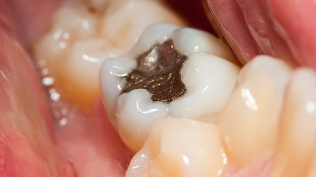 Clampdown on silver fillings in EU could affect YOU: Warning that Bloc's proposed amalgam ban could disrupt care in the UK