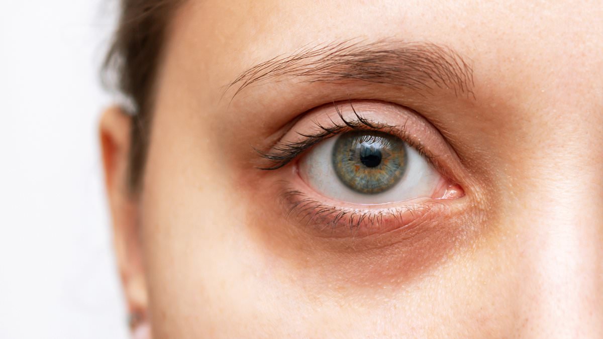 Dermatologist reveals there are FOUR types of dark circles - which one do you have?