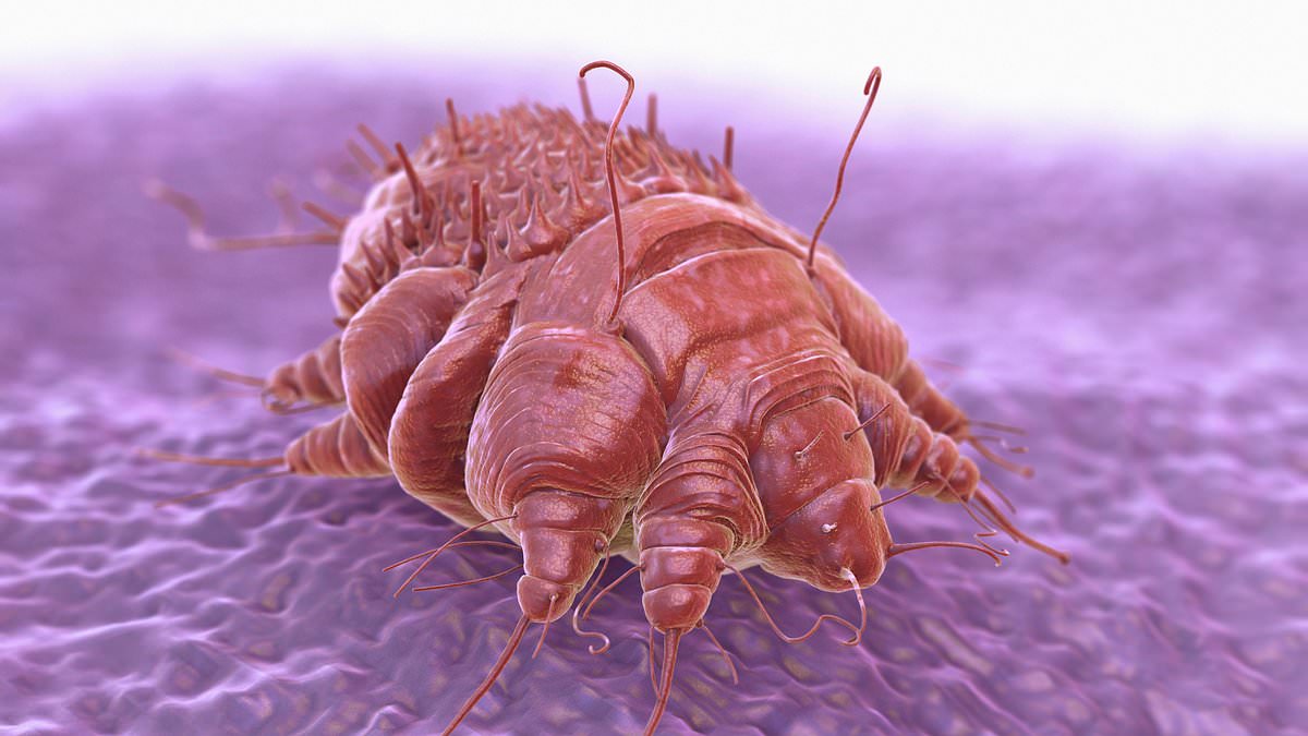 Doctors report 'nightmare' surge in highly contagious itchy skin condition caused by tiny mites