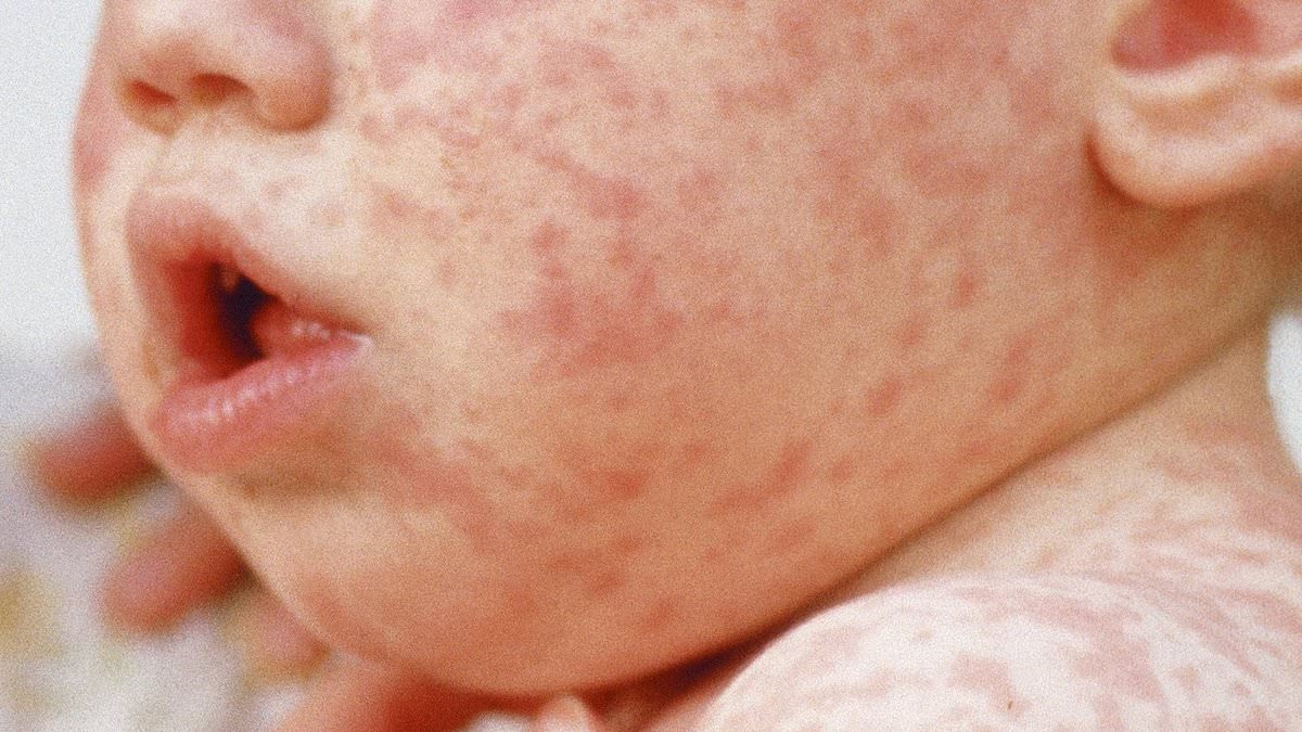 England's measles hotspots REVEALED amid surge in cases blamed on slump in MMR vacccination rates