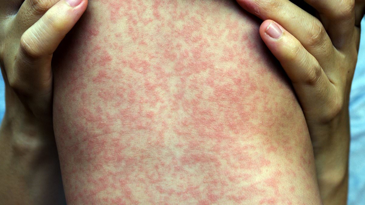 Measles outbreak in Pennsylvania's top children's hospital has health officials concerned- as more kids than ever are unvaccinated against the deadly disease