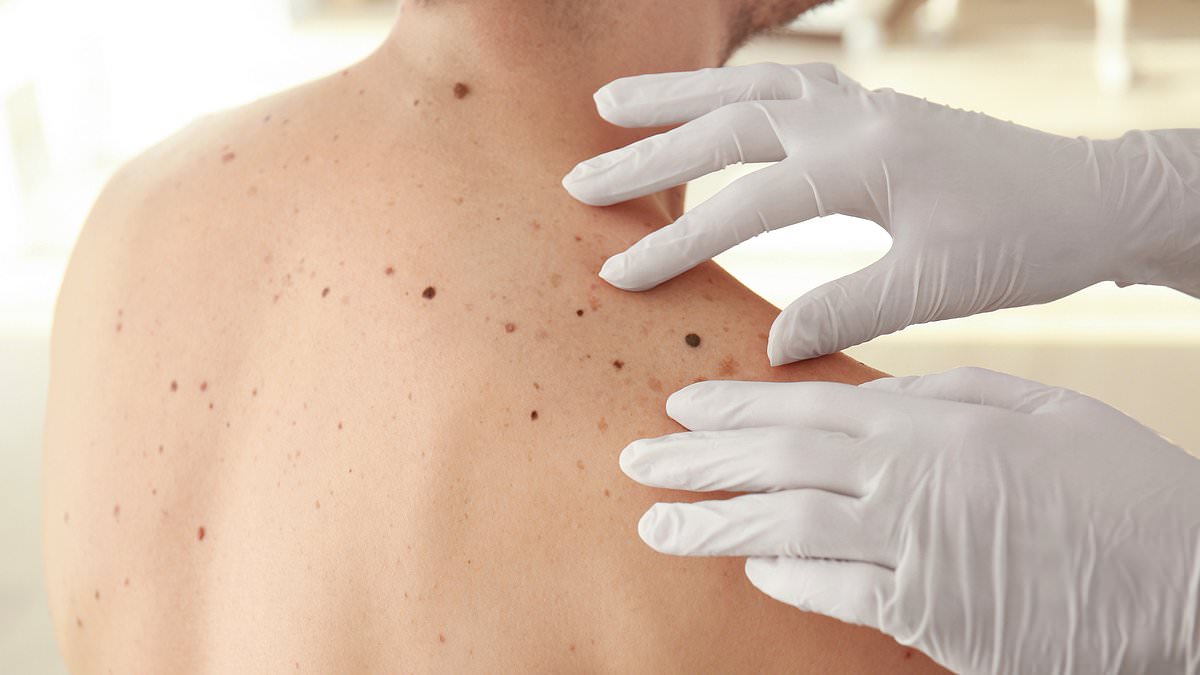 NHS regulators clear new skin cancer drugs combo to treat patients who suffer gruelling side effects from current treatments