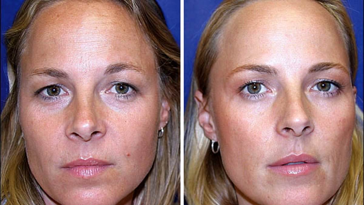 One identical twin, 38, had Botox for 20 years - the other didn't. Who do YOU think looks better?