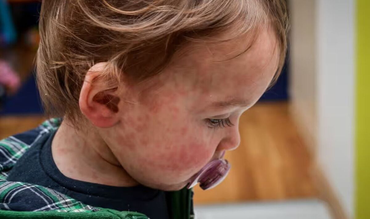 Parents issued urgent warning as measles cases more than double in UK