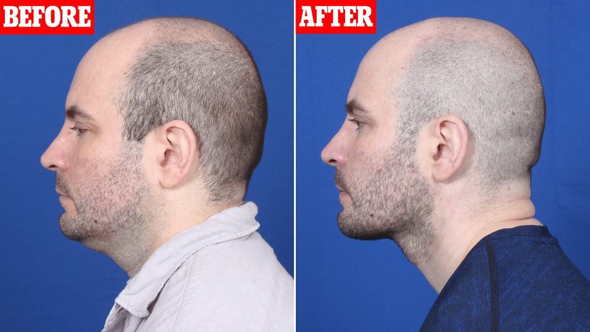 The lunch-hour neck lift! Texas man, 38, is 'going on more dates than ever' after getting 45-minute procedure to enhance his jawline which plastic surgeons say is 2024's biggest trend