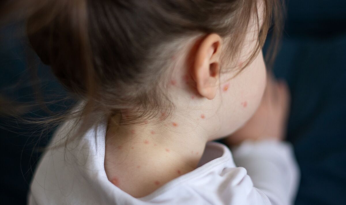 UK measles latest: WHO sounds 'urgent' alarm about 30-fold spike in virulent disease
