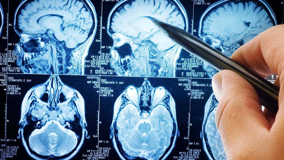 Using MRI scans to 'massage brain' could ease depression symptoms for up to SIX months
