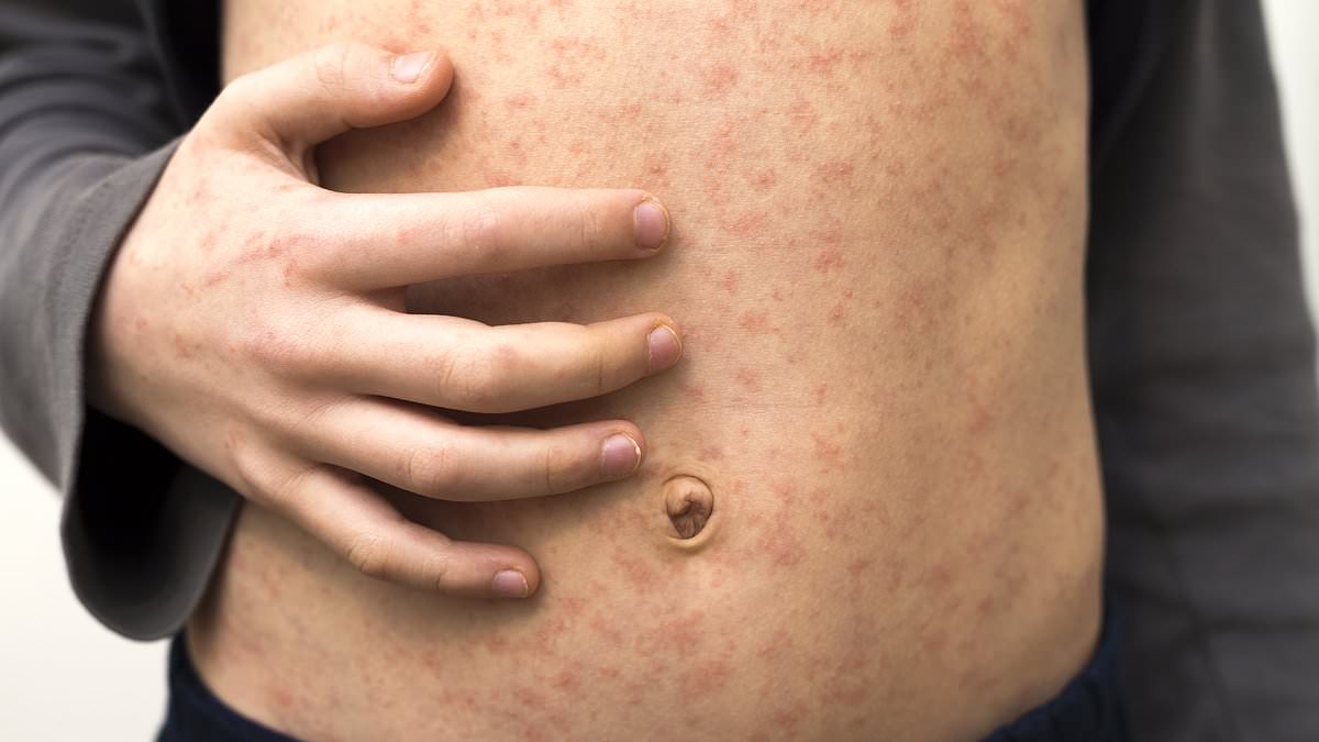 Warning over 'alarming' 45-fold rise in measles cases across Europe as WHO chiefs urge parents to make sure kids have had both MMR jabs before going on holiday