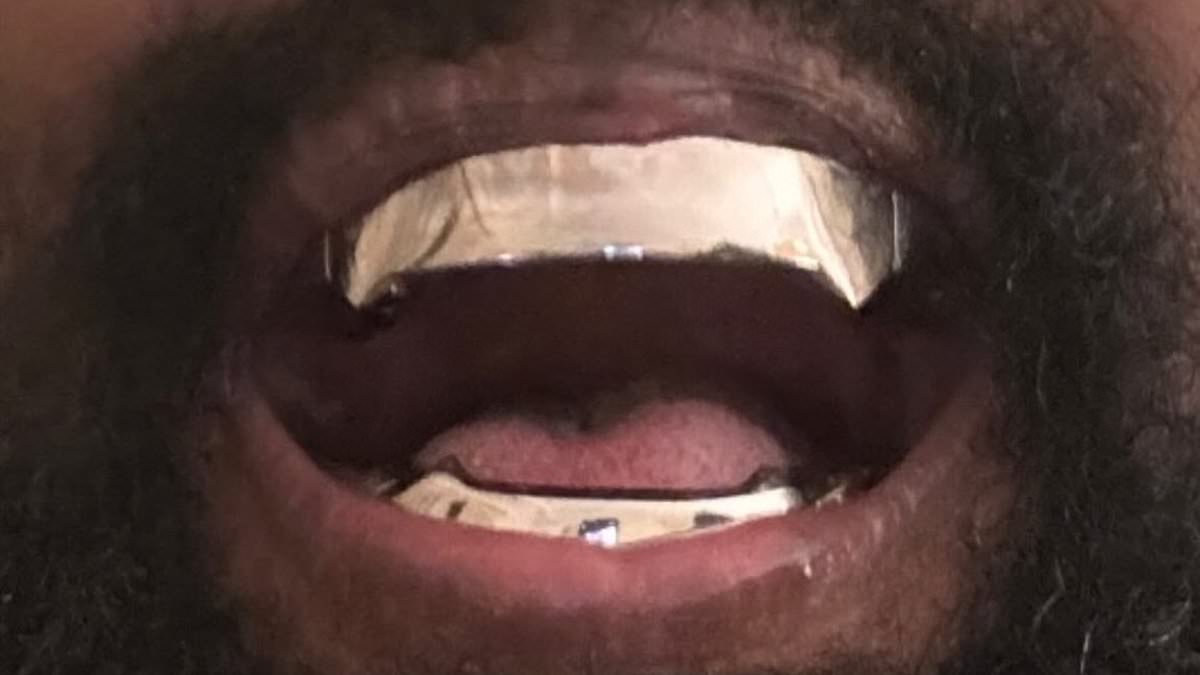 Why 'grills' can give you honking breath: As Kanye West 'replaces his teeth with $850,000 titanium band', dentists warn of side effects of trend peddled by likes of Rita Ora, Rihanna and Katy Perry