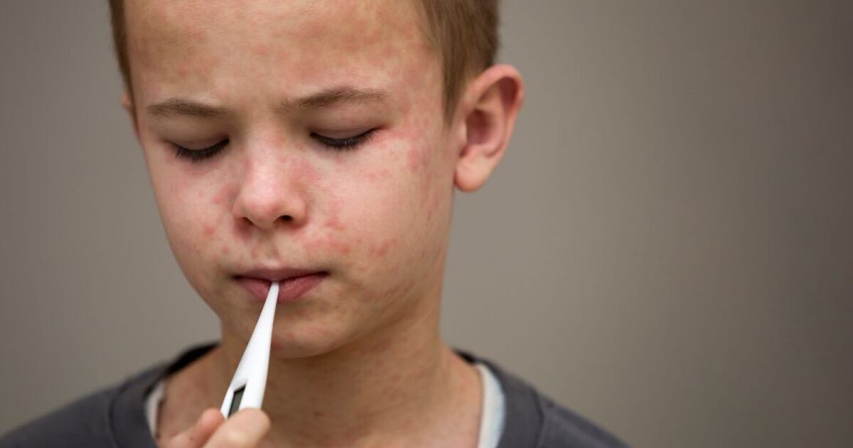 'Clusters' of measles cases now being reported across England - check affected areas