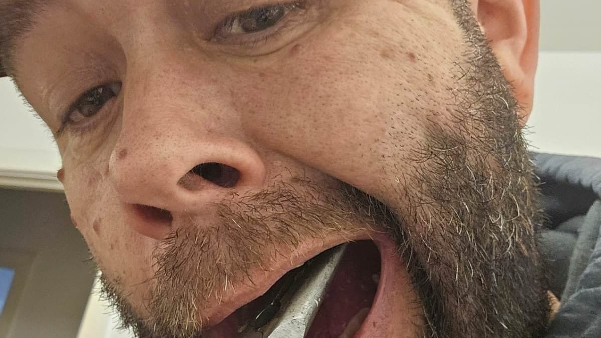 Father, 50, pulls out his own tooth with pliers after failing to get an NHS dentist appointment for six months