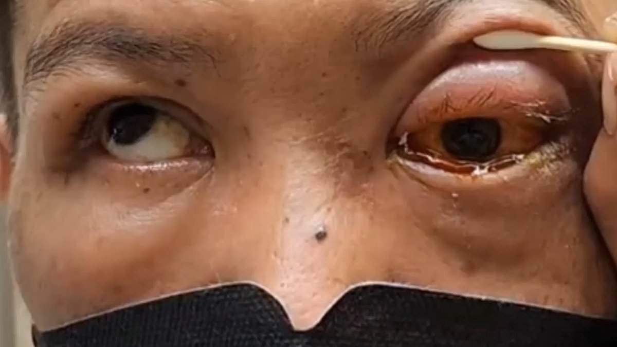 Man, 44, goes partially BLIND after falling asleep face down while drunk and rupturing the blood vessels in his eyeball