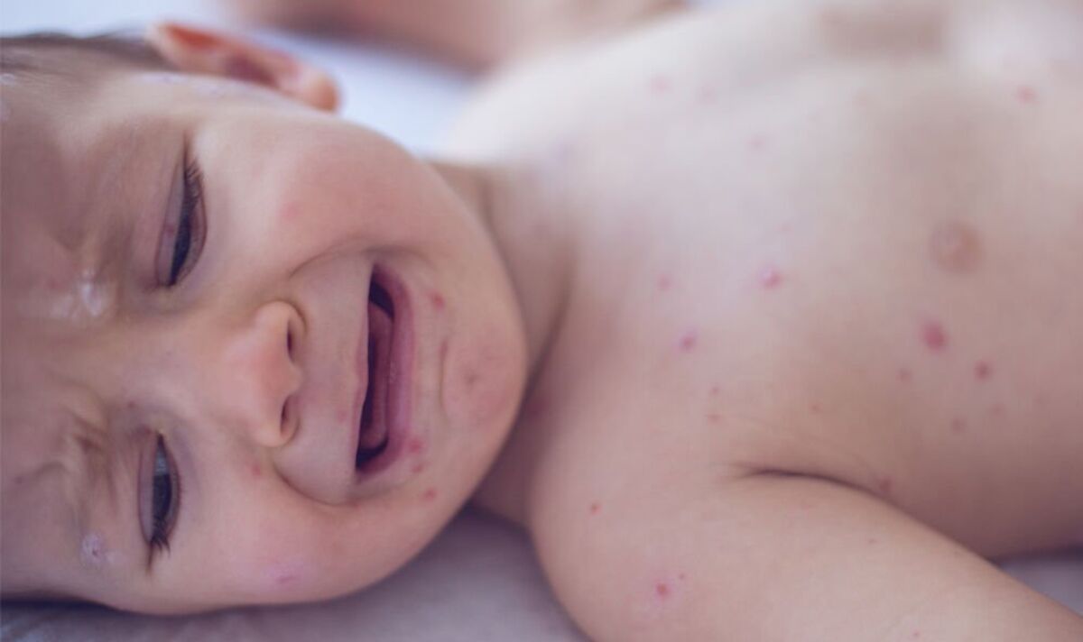 Measles outbreak mapped: The UK city identified as hotspot as cases continue to rise