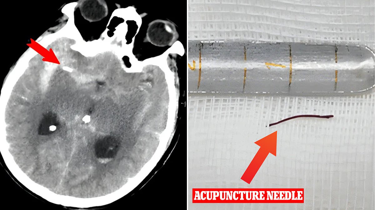 Patient, 74, who went to doctors fearing he had an aneurysm is found to have an acupuncture needle lodged in his brain that had been there for 20 YEARS