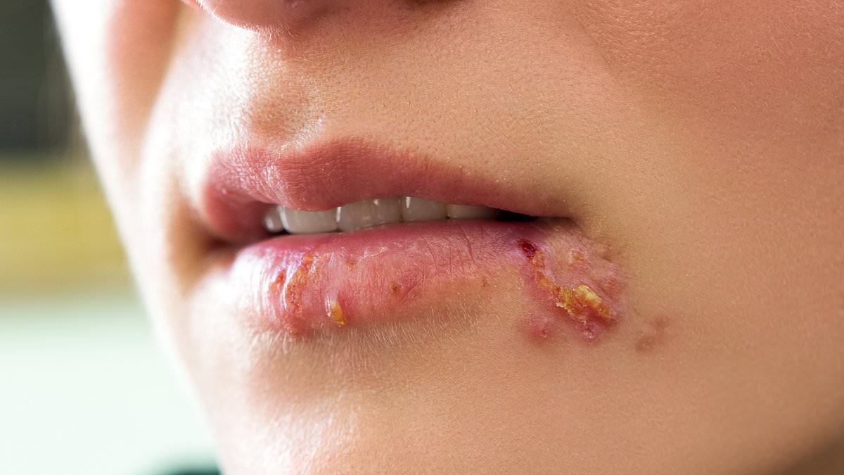 Prone to cold sores? You may have DOUBLE the risk of dementia later in life, study suggests