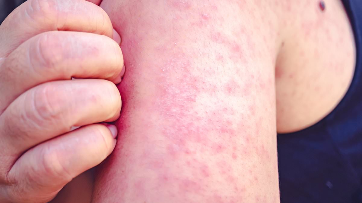 America on verge of measles MAYHEM: Hundreds feared to be infected in California and Arizona outbreaks as US suffers year's worth of cases in two months - as doctors say antivaxxers and Biden's open border policy are allowing virus to spread