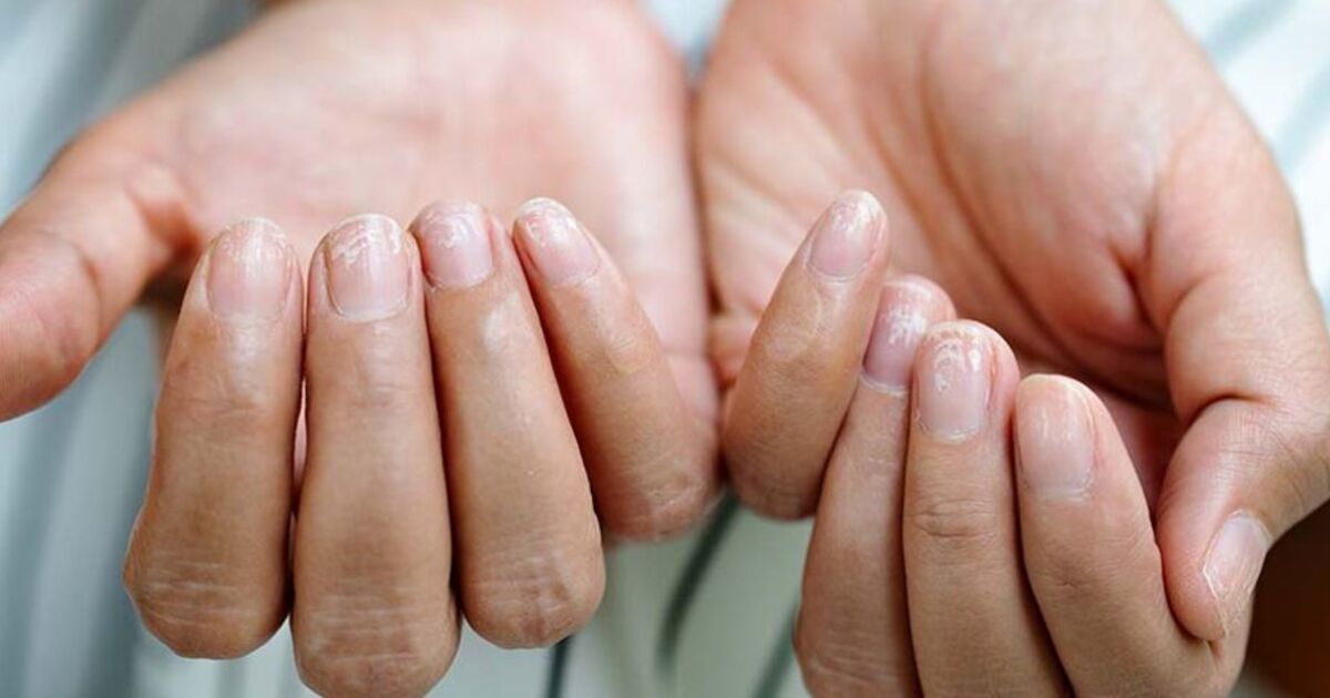 Little-known sign in your nails could be red flag symptom of ‘aggressive’ cancer