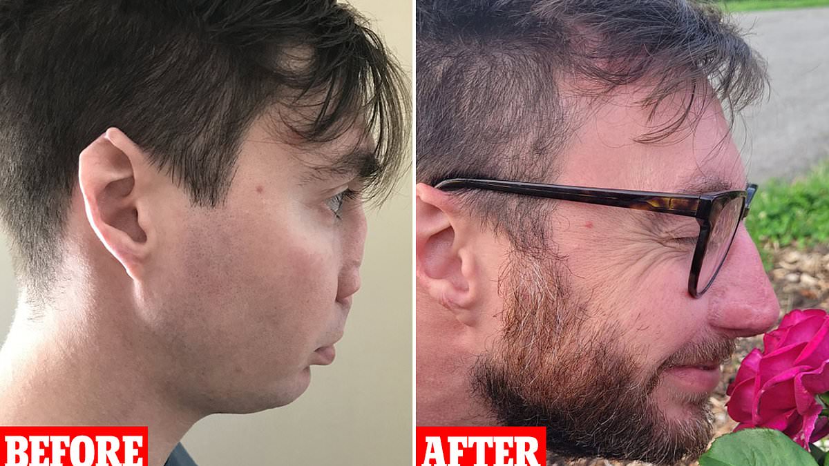 Massachusetts man, 37, whose face was ravaged by a pet dog has incredible transformation after surgery