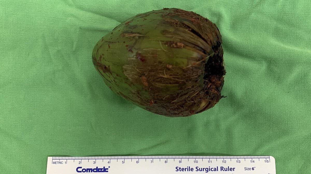 Taiwanese man, 56, needs COCONUT removed from his rectum