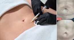 Could you endure 40 jabs of 'injectable moisturiser' at a cost of £850 to smooth out wrinkly mummy tum?