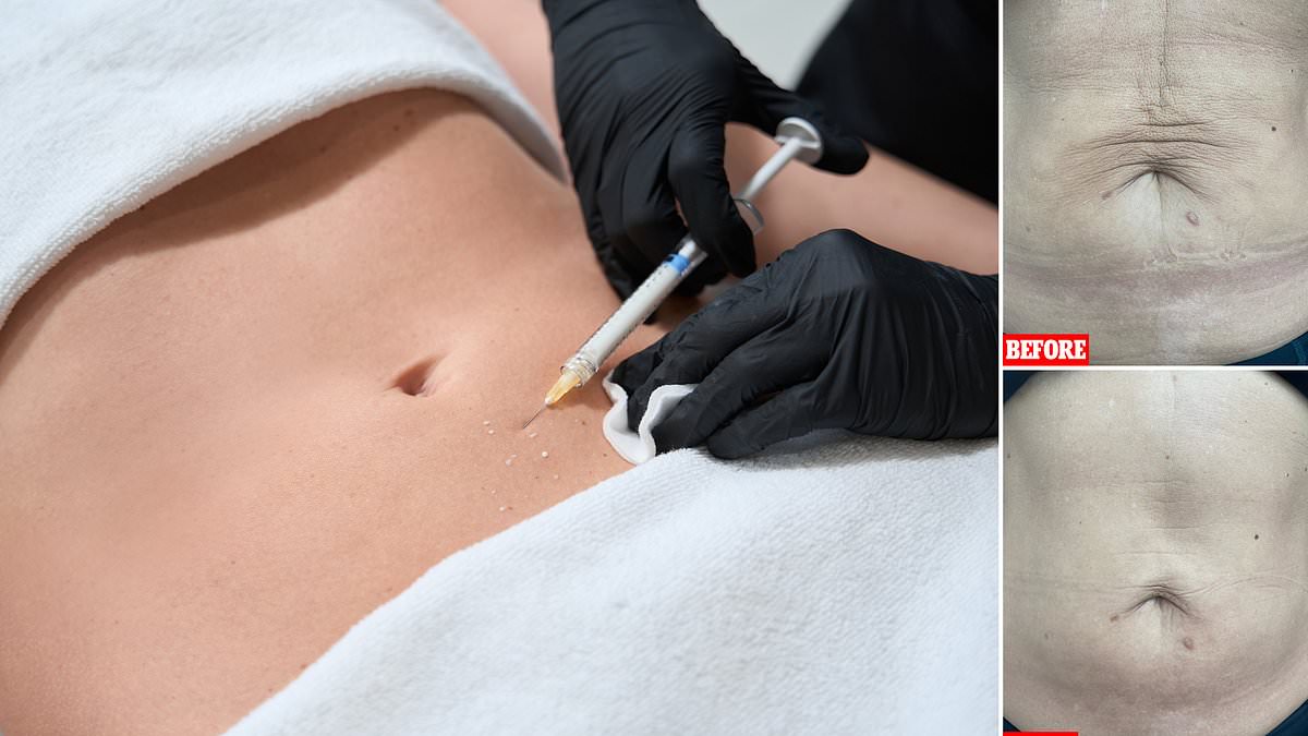 Could you endure 40 jabs of 'injectable moisturiser' at a cost of £850 to smooth out wrinkly mummy tum?