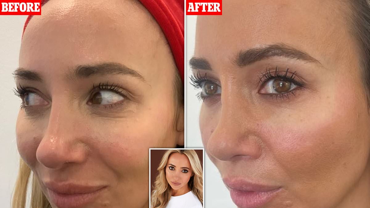 I injected my face with salmon sperm to rejuvenate my skin: Top cosmetic doctor, 40, shares incredible before-and-after pictures of bizarre, wrinkle-defying £450 beauty trend loved by Jennifer Aniston