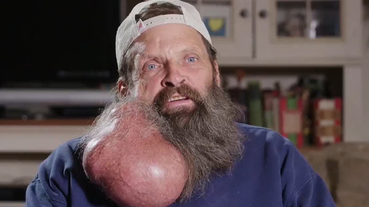Incredible transformation of mechanic, 62, who's 'little pimple' grew into a 5lb watermelon-sized tumor over 16 years before doctors finally manage remove it without any facial damage