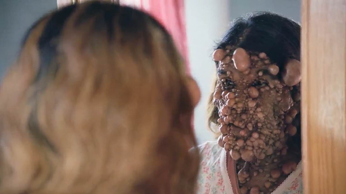 Woman's 'one-of-a-kind' disease causes thousands of TUMORS to grow all over her body- including in her nose and mouth