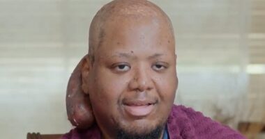 'I feel like a monster': California recluse, 33, hid for more than a decade after cantaloupe-sized tumor grew on his head and smelled so bad it caused people to faint