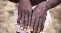 Congo is suffering biggest mpox outbreak ever that could soon spread to US...after arrival of new, ultra-infectious, deadly strain, CDC report warns