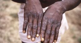 Congo is suffering biggest mpox outbreak ever that could soon spread to US...after arrival of new, ultra-infectious, deadly strain, CDC report warns