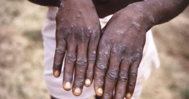 Congo is suffering biggest mpox outbreak ever that could soon spread to US...after arrival of new, ultra-infectious, deadly strain, CDC report warns