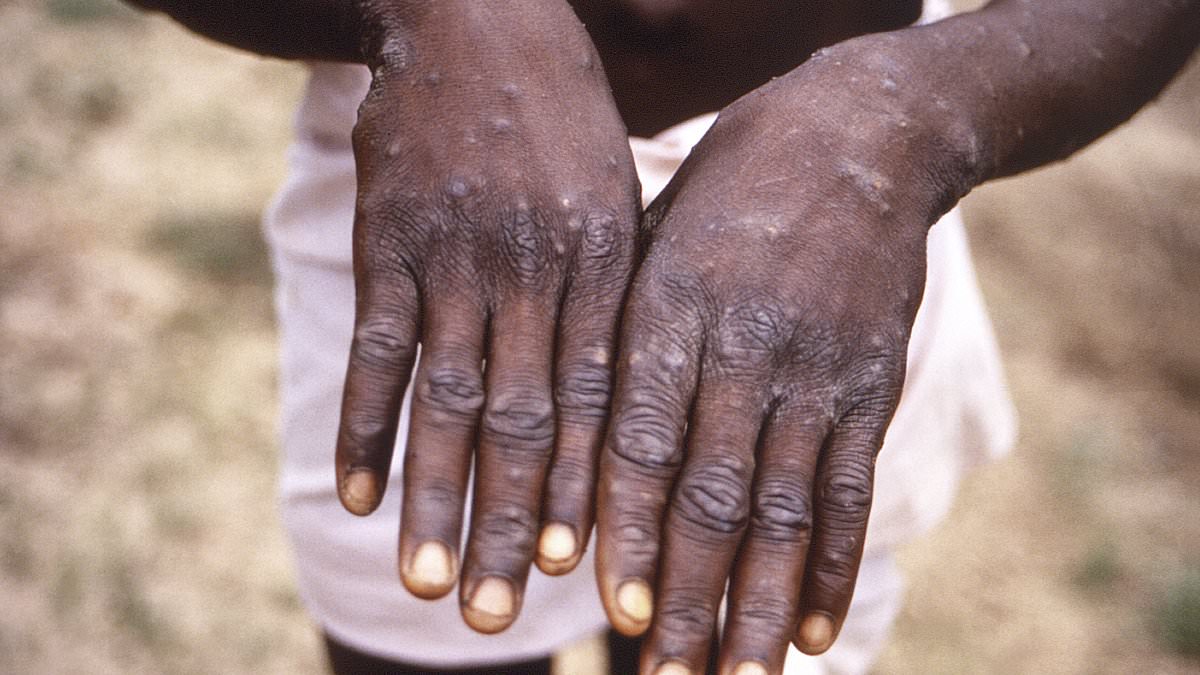 Congo is suffering biggest mpox outbreak ever that could soon spread to US...after arrival of new, ultra-infectious, deadly strain, CDC report warns