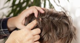 Headlice warning issued as leading high street retailer sees spike in sales for treatment