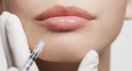 My facial fillers gave me an oozing pus-filled 'tumor' on my chin...and I had to pull 'worms' out of it